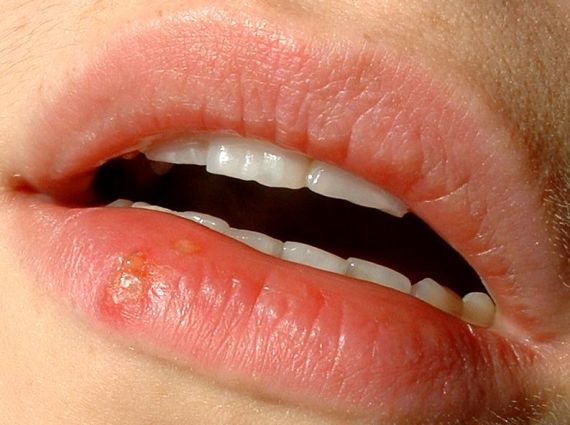 Herpes labial, uno de los más habituales y también molestos.